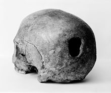 Trepanned skull from Edinburgh Edinburgh Skull, trepanning showing hole in back of skull Wellcome M0009393.jpg