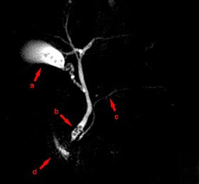 MRCP Choledocholithiasis.jpg