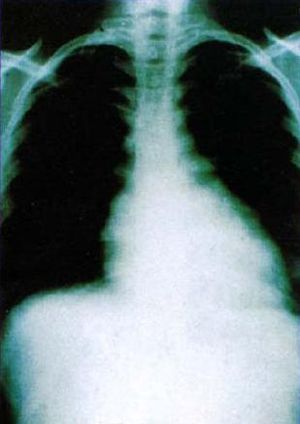Chagas heart, radiology