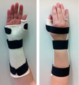 Volar & Dorsal Views of Orthosis