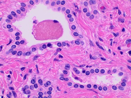Histopathology of a bile duct hamartoma, high magnification, H&E stain. It shows typical features of bile duct hamartoma: Small to medium sized, irregularly shaped bile ducts lined by bland cuboidal epithelium (may also be flattened). Prominent intervening collagenous stroma. Bile ducts containing eosinophilic debris (may also contain inspissated bile)