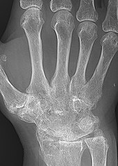 Rheumatoid arthritis with carpal ankylosis 2017.jpg