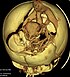Obraz angiografii tomografii komputerowej w rekonstrukcji 3D u niemowlęcia. Widać tętniakowato poszerzoną żyłę wielką mózgu.