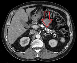 Axial CT showing multiple calcifications in the pancreas in a patient with chronic pancreatitis