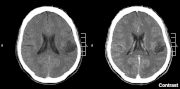 Miniatura para Glioma