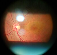 Fundoscopy by using 90 diopter lens with the slit lamp Slit lamp fundoscopy.jpg