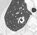 Cavitation with relatively thick wall, in this case aspergilloma).[9]