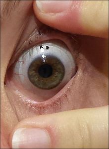 Scleral lens, with visible outer edge resting on the sclera of a patient with severe dry eye syndrome Scleral lens worn on an eye.jpg