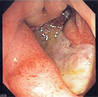 Endoscopic image of deep gastric ulcer in the ...