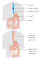 استئصال المريء باستخدام الأمعاء (القولون) لتحل محل المريء