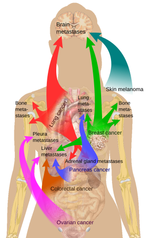 Main sites of metastases for some common cance...