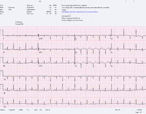 תרשים א.ק.ג. המדגים Electrical Alternans