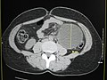 Large abdominal cyst.