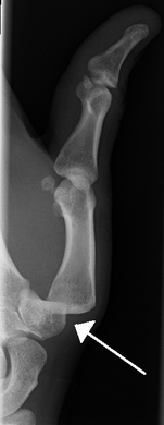 Dislocation of the carpo-metacarpal joint.