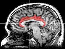 Sagittal MRI slice with highlighting indicating location of the cingulate cortex.