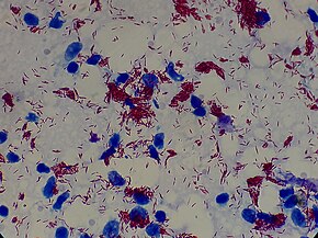 M. leprae, one of the causative agents of leprosy: As an acid-fast bacterium, M. leprae appears red when a Ziehl-Neelsen stain is used. Mycobacterium leprae in Magnification of 2000X.jpg