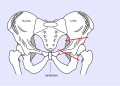 Skizze der Hüftdysplasie li. mit eingezeichneten Osteotomielinien