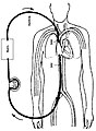 Veno-venski modalitet (VV-ECMO)