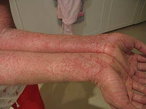 Eczema on arms.