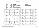 Vignette pour Trouble du rythme cardiaque