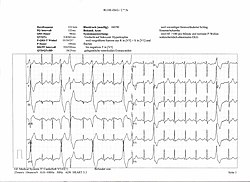 rendellenes görbék 12-csatornás EKG-n