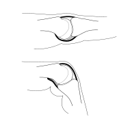 Metacarpophalangeal joint illustration.svg