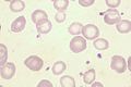 Anisocytose et hypochromie