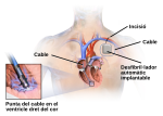 Miniatura per Desfibril·lador automàtic implantable