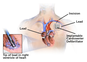 Illustration of an implantable cardioverter-defibrillator (ICD) Blausen 0543 ImplantableCardioverterDefibrillator.svg
