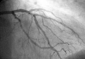 A coronary angiogram that shows the LMCA, LAD ...