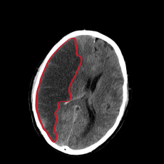 CT-kuva iskeemisestä aivoinfarktista kuvan vasemmalla puolella.