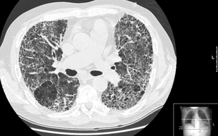 HRCT of lung showing extensive fibrosis possibly from usual interstitial pneumonitis. There is also a large bulla. Pulmon fibrosis.PNG