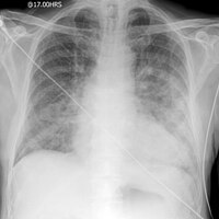 AP portable CXR of a patient in acute pulmonary oedema.jpg