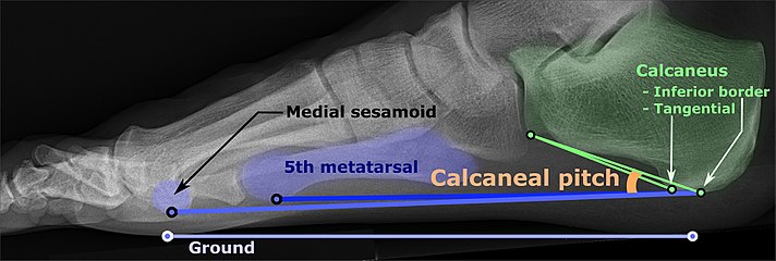 Weight-bearing lateral X-ray showing the measurement of calcaneal pitch, which is an angle of the calcaneus and the inferior aspect of the foot, with different sources giving different reference points.[15] Calcaneal pitch is increased in pes cavus, with cutoffs ranging from 20° to 32°.[14]