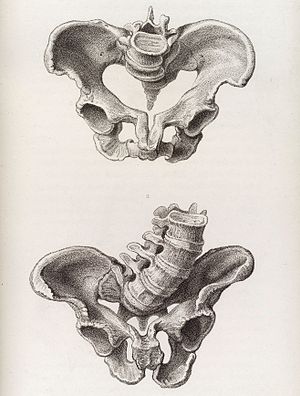 Illustration of a deformed female pelvis - angular distortion Wellcome L0038229.jpg