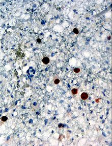 Иммуногистохимическое обнаружение белка «Полиомавирус человека 2» (окрашен в коричневый цвет) в биопсии головного мозга (глия демонстрирует прогрессирующую мультифокальную лейкоэнцефалопатию (ПМЛ))