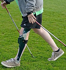 A patient after incomplete paraplegia (lesion height L3) with a knee-ankle-foot orthosis (KAFO) with an integrated stance phase control knee joint Orthese Querschnittlahmung.jpg