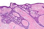 Фиброэпителиоматозная картина базальноклеточного рака - low mag.jpg
