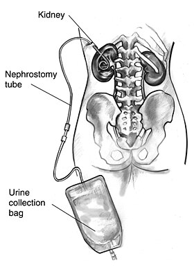 N01224 H nephrostomy.jpg