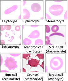Variations of red blood cell shape, overall termed poikilocytosis. Poikilocytes - Red blood cell types.jpg