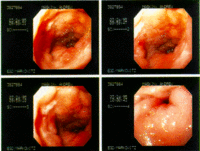 Endoscopic images of a duodenal ulcer