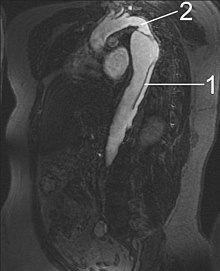 MRI of an aortic dissection1 Aorta descendens with dissection2 Aorta isthmus