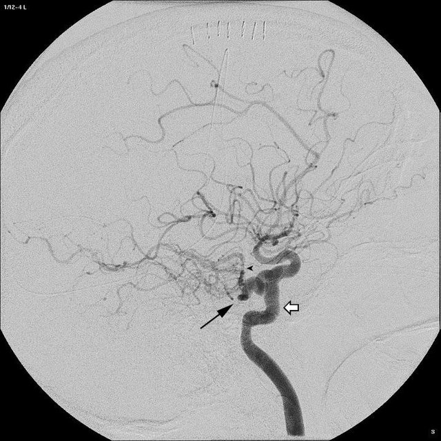 Persistent trigeminal artery