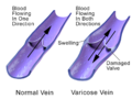 Varicose vein