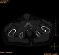 CT einer Prostatakrebs-Metastase im linken Schambein (im Bild rechts)