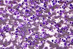 Miniatura per Limfoma difús de cèl·lules B grans
