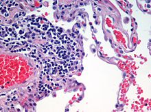 Microscopic view of a histologic specimen of human lung, consisting of various tissues: blood, connective tissue, vascular endothelium and respiratory epithelium, stained with hematoxylin and eosin. Emphysema H and E.jpg