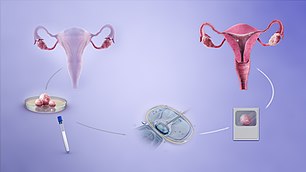 A depiction of the procedure of in-vitro fertilization