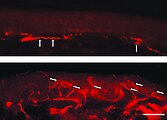 Fluoreszenzmikroskopaufnahmen eines Gefrierschnittes der Haut eines Morbus-Fabry-Patienten. Auffällig ist der Mangel an intraepidermalen Nervenfasern und das Vorhandensein von Fasern, die zum subepidermalen Nervenplexus gehören (Pfeile). Die untere Hautprobe stammt dagegen vom Rücken des Patienten. Hier ist die dichte Innervation der Epidermis (Pfeile) auffällig.