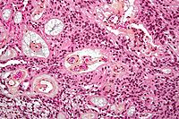 Micrograph of a myxopapillary ependymoma. HPS stain.